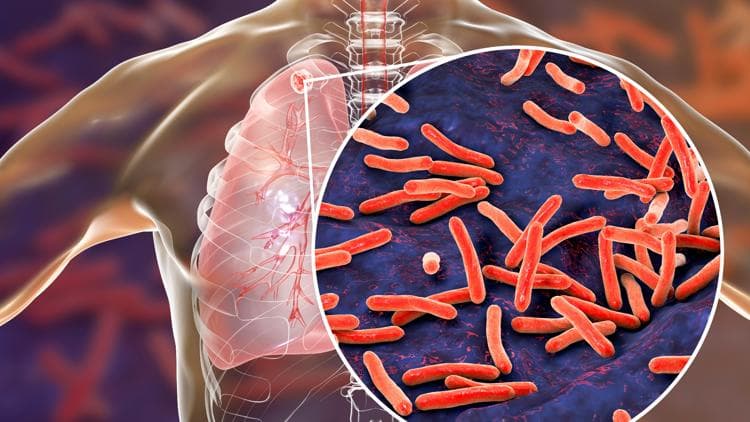 SC Health Dept Responds to TB Exposure at Fort Mill School