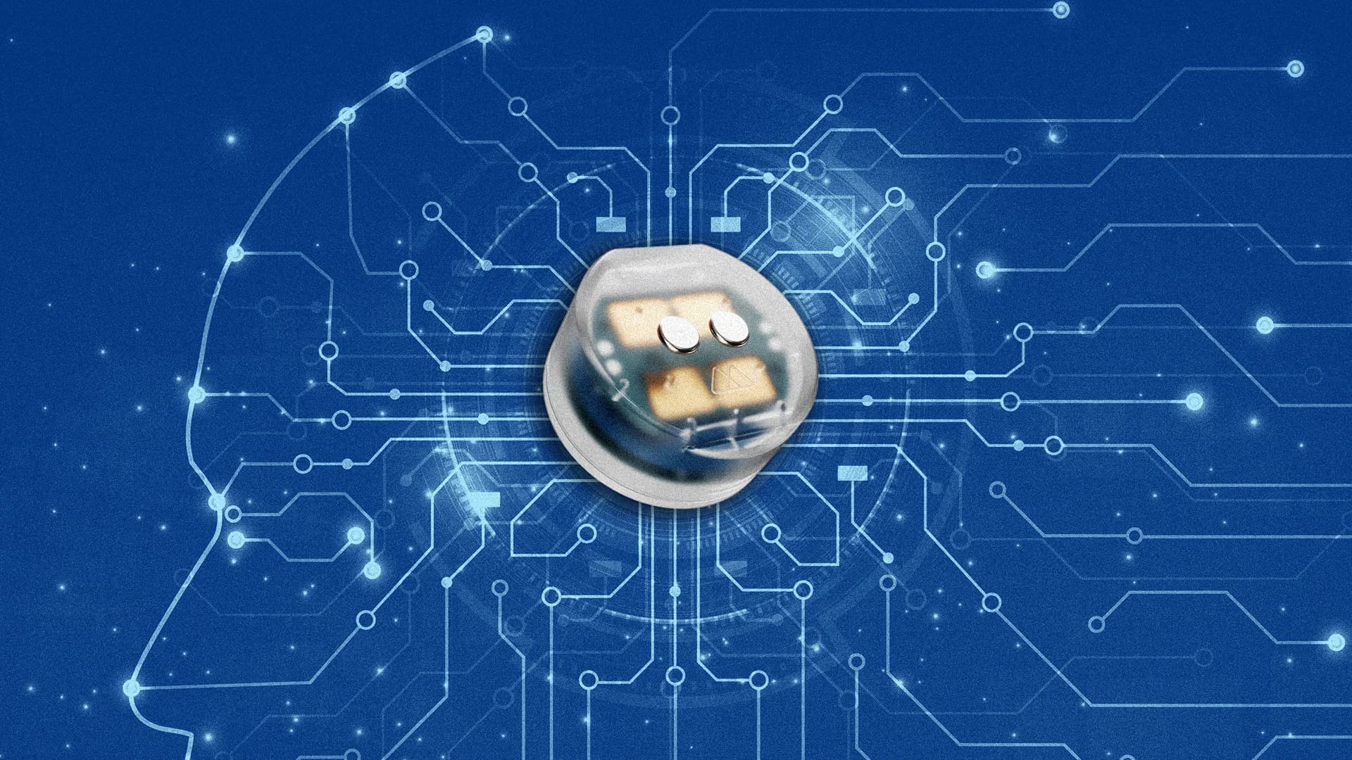 Brain Implant Breakthrough Offers New Hope for Depression Treatment