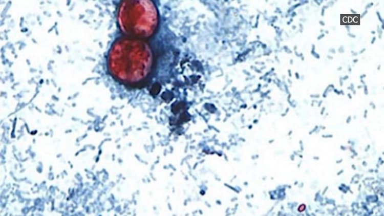 NC Cyclosporiasis Outbreak Surpasses 867 Cases; Source Still Unknown